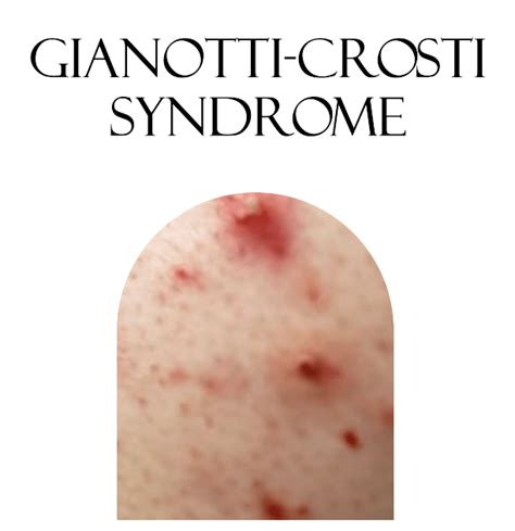 What Is A Gianotti Crosti Bootdash