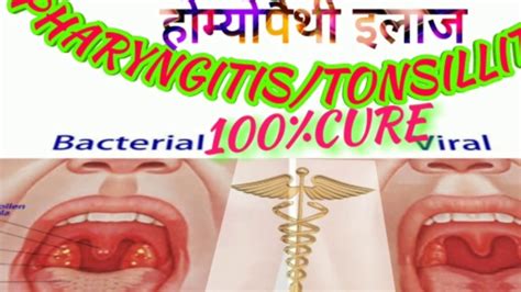 Homeopathic Treatment Of Pharyngitis Throat Infection Live Case Taking