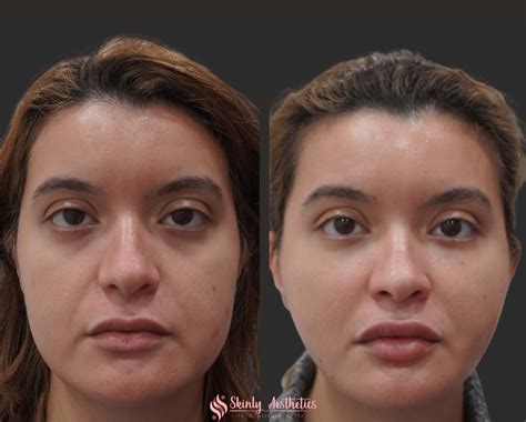 Cheek Filler Injections Benefits Costs Results And Procedure Steps