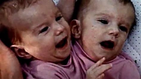 years after these siamese twins were born they shared shocking news about them let s see why