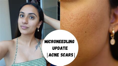 Microneedling Review Update Part 1 Acne Scars Before And After