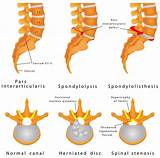 Spondylolisthesis Physical Therapy Treatment Images