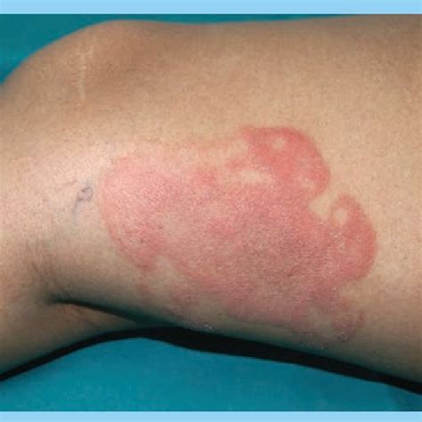 Patch Stage Mycosis Fungoides Showing Erythematous Scaly Patches In The