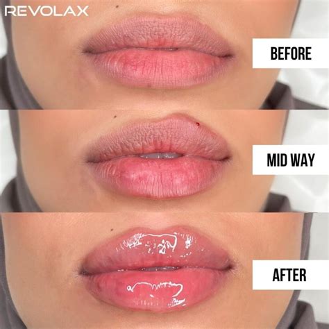 Lip Filler Before And After Photos And Results The Daily Glimmer