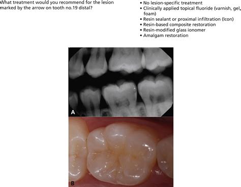 Management Of Initial Carious Lesions The Journal Of The American