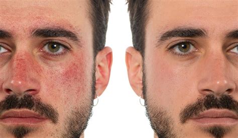 Premium Photo Before And After A Treatment For Rosacea In A Mans Face