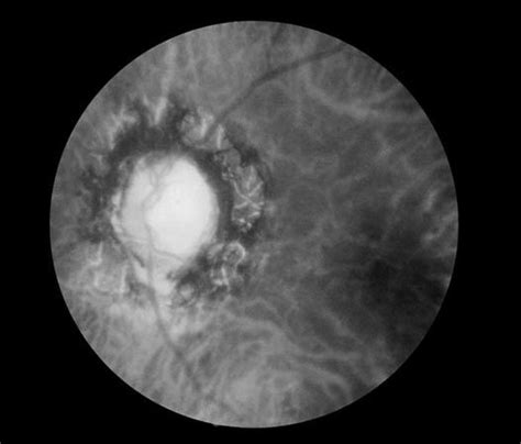 Optic Atrophy Pathology Britannica