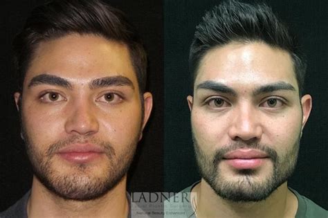 Facial Plastic Surgery For Men Before And After Photo Gallery Denver