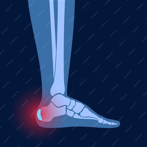 Premium Vector Heel Bursitis Inflammation Inflamed Bursa In Human