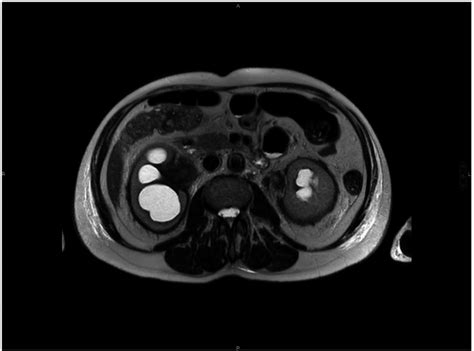 Axial T2‐weighted Abdominal Mri Shows Bilateral Mild Perinephric Soft