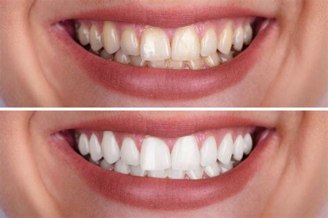 Can Teeth Whitening Damage Tooth Enamel