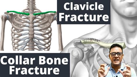 Clavicle Bone Clavicle Fracture Broken Collar Bonemanagement