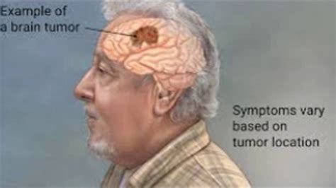 Brain Tumor Symptoms Youtube