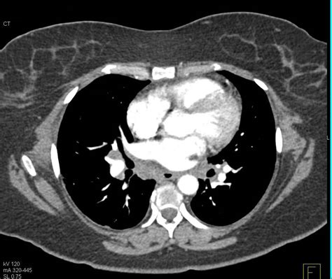 Sarcoidosis Involves The Spleen With Acute Pancreatitis As Well