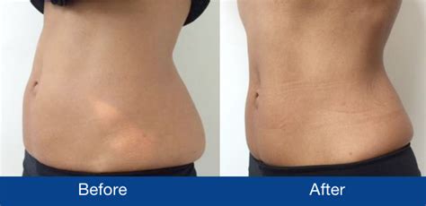 The pain can be described as dull and persistent. CoolSculpting results (cryolipolysis) in London | Epilium & Skin