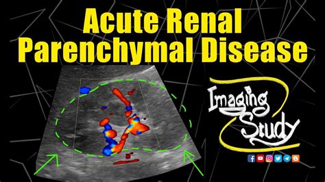 Acute Renal Parenchymal Disease Ultrasound Case Youtube