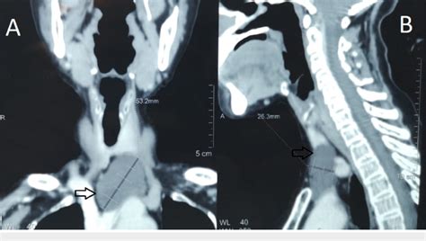 A And B Cervical Computed Tomography Scan Showing Left Sided Cervical