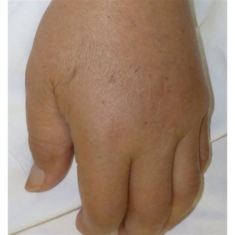 Photographs Of The Bilateral Hands And Feet Edematous Hands And Feet