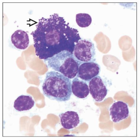 Lymphoplasmacytic Lymphoma Basicmedical Key