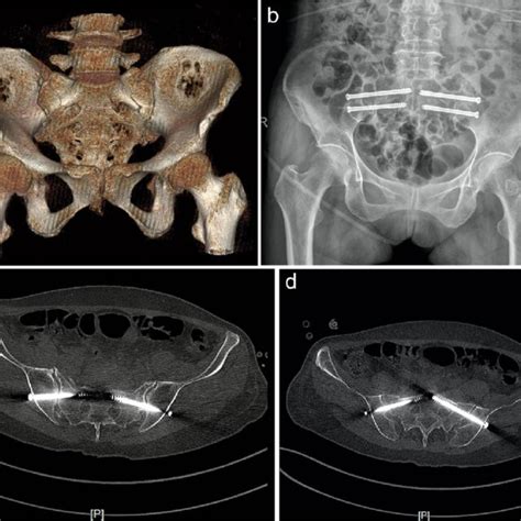 A 67 Year Old Female Patient With Bilateral Sacroiliac Joint Injury A