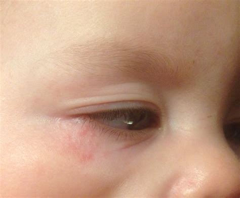 Tiny Red Dots Under Los Eye Babycenter