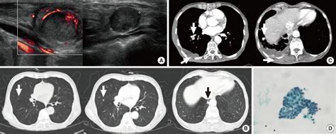 A Neck Sonography Showed Metastatic Lymph Nodes In The Right Lower