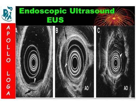 Upper Gi Endoscopy A Pictorial Overview