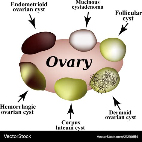 Types Ovarian Cysts Set Infographics Illustration Hot Sex Picture