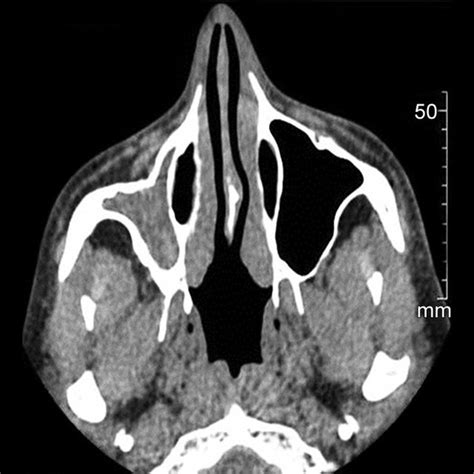 Ct Scan Of Paranasal Sinus — Coronal View Showing Normal Frontal Sinus