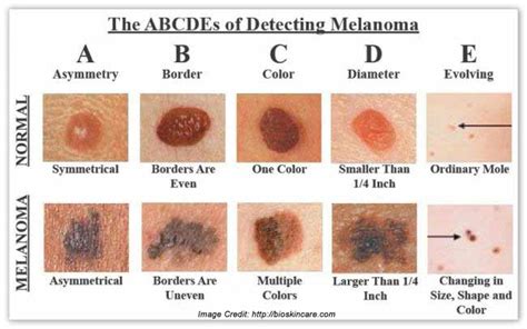 Spotting A Melanoma Early Hoppers Lane General Practice