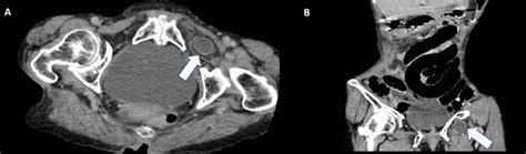 Strangulated Obturator Hernia In A Covid 19 Patient A Rare Case