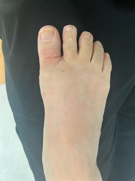 Bunion Surgery Before And After Photos Northwest Surgery Center