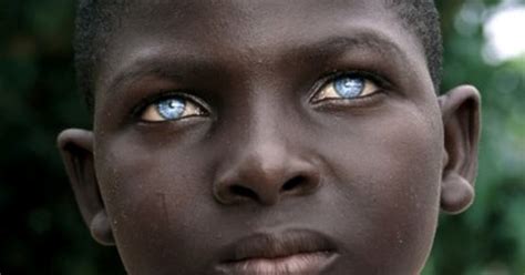 Acting White Acting Black Healthy African Boy With Rare Blue Eyes