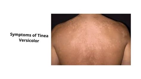 Tinea Versicolor List Of Causes Symptoms And Diet