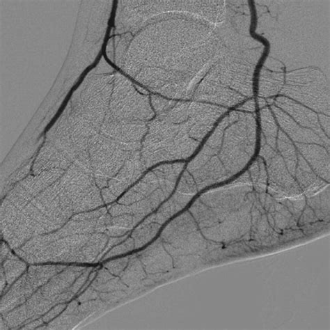 Angiogram Showing Thrombosis Of The Profunda Femoris And Lateral