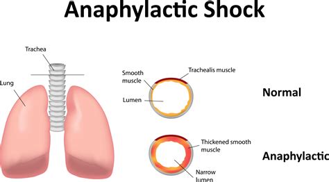 Anaphylaxis Anaphylactic Shock Nursing Review Of The Treatment Signs And Symptoms Nursing