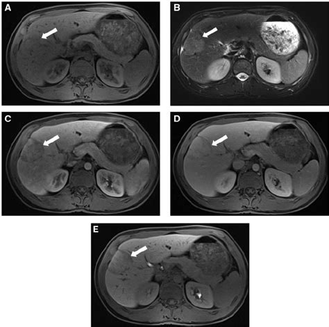 Mri Of The Liver The Right Hepatic Lesion Is Mildly Hypointense On