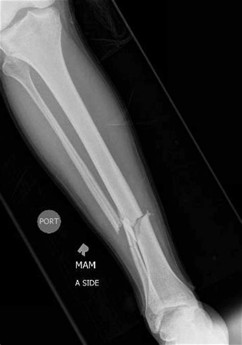 Tibia Fracture Questions About The Injury Treatment And Recovery Dr