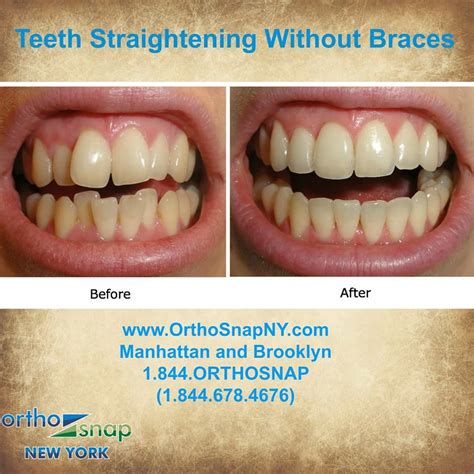Invisalign is a great way to straighten your teeth without the hassle or discomfort of traditional metal braces. Pin by Rick Dawner on Beautiful Smile | Pinterest ...