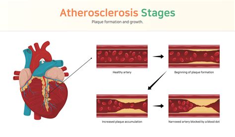 Atherosclerosis Bhf