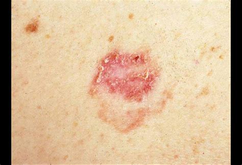 Nonmelanoma Skin Cancers You Need To Know