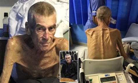 Six Stone Emaciated Man 64 Left Starving And Unable To Stand But Deemed Fit To Find Work