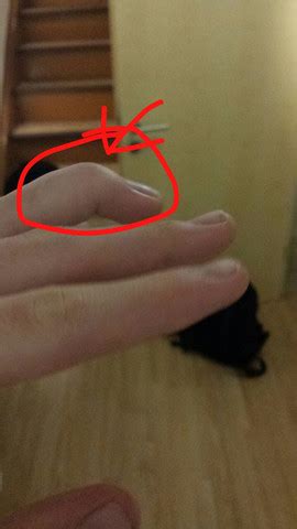 Der betroffene verspürt eine schmerzhafte schwellung und seine bewegungsfreiheit ist infolge von dem kapselriss im finger eingeschränkt beim arzt kam dann raus, dass ich einen kapselriss habe. Was ist mit meinem Finger passiert ? (Football, Band, hand)