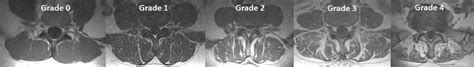 Goutallier Classification Every Grade Was Defined As Follows Grade 0