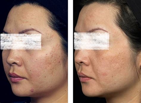 Acne Scars Treatment In Dubai Laser Skin Care Clinic
