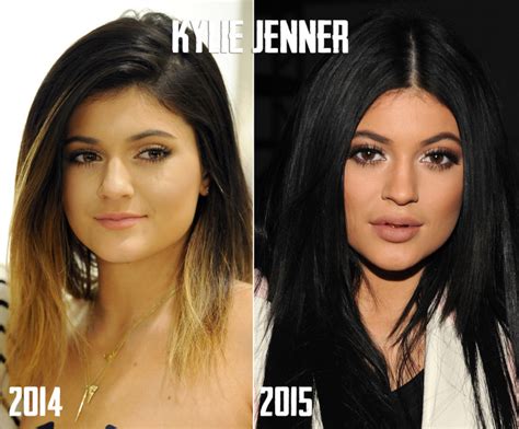 Kylie Jenner Lip Challengethe Truththe Dangerthe Fillers