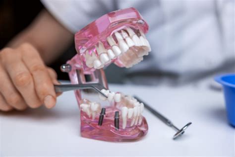 Qu Es Un Puente Dental Tipos Y Caracter Sticas Clinica Dental Oris