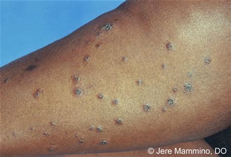 Atopic Eczema On Black Skin