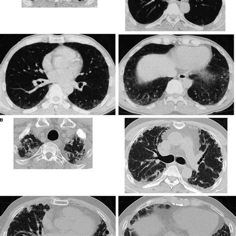 A Chest Computed Tomography Ct Scan Taken At The Age Of 56 Years