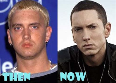 Eminem Plastic Surgery Before And After Botox Lovely Surgery